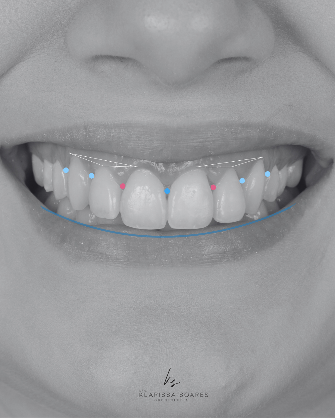 Análise estética do sorriso