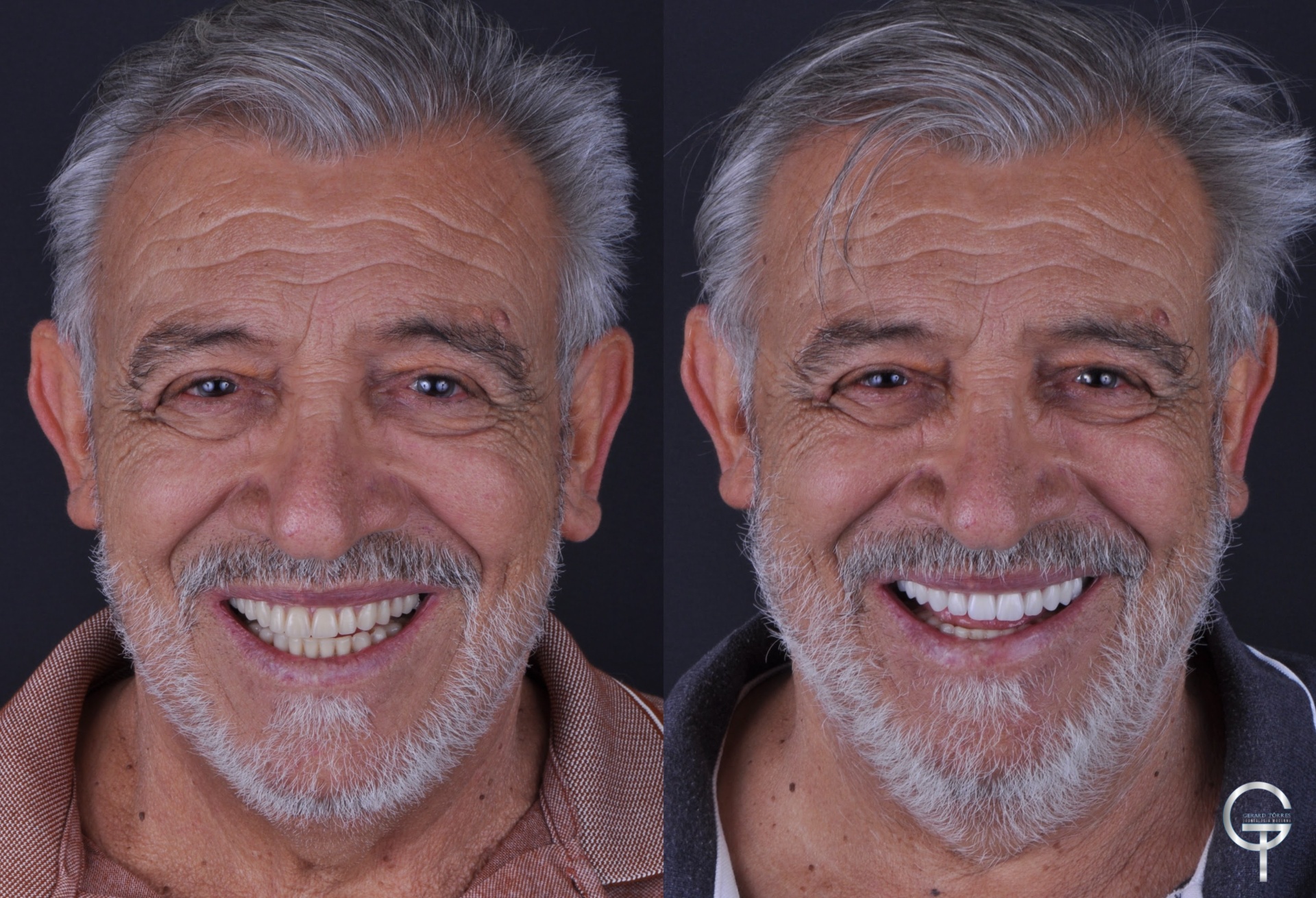 Antes e depois de reabilitação