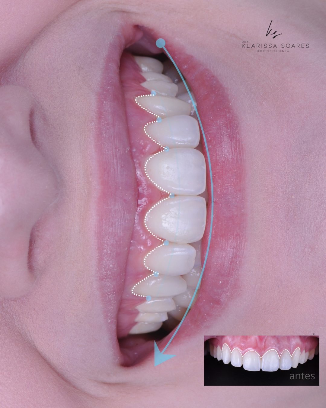 Planejamento de sorriso lateral